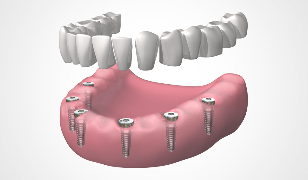 implantes dentales en Esparreguera